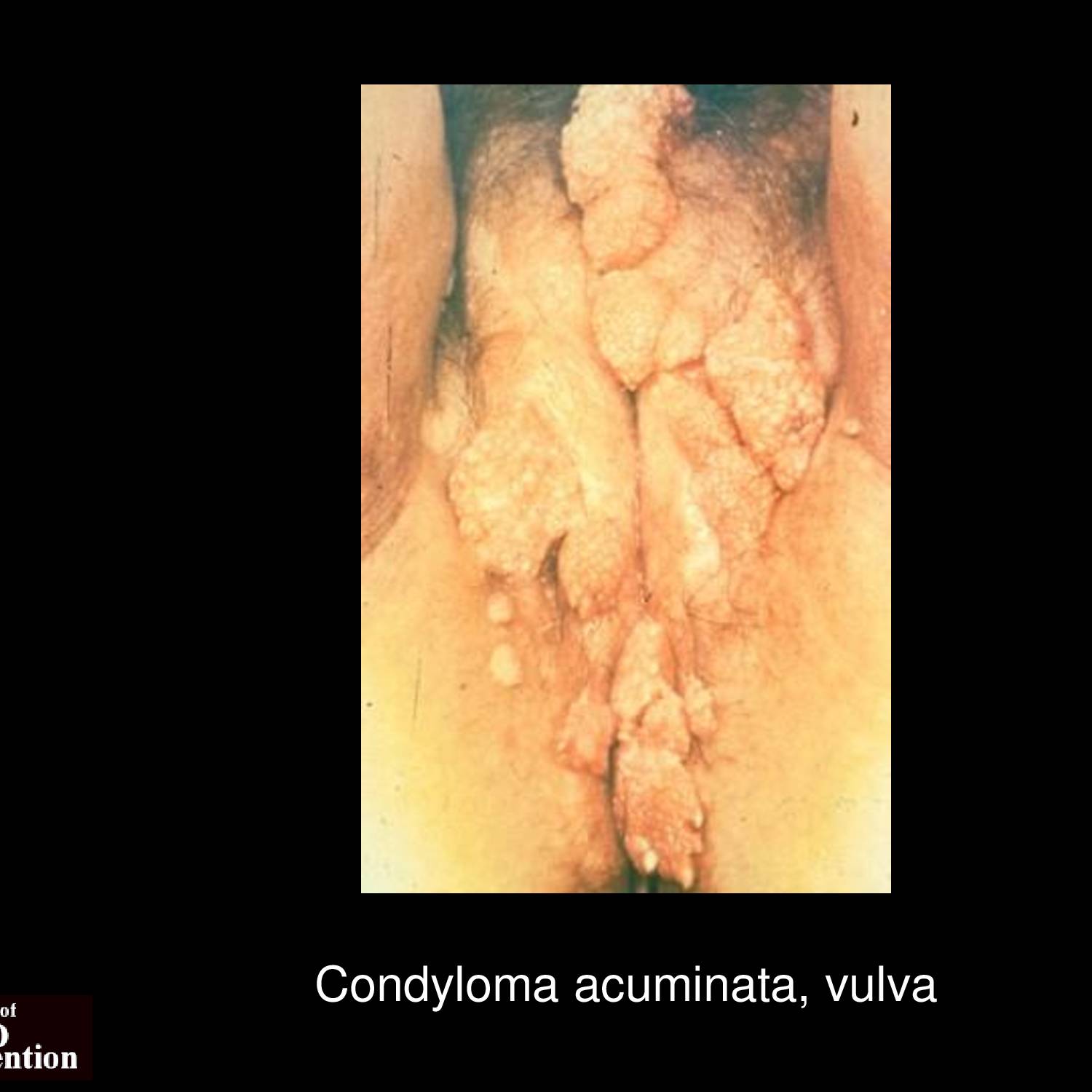 Condyloma acuminata lesions on scrotum showing multiple small flesh-colored papules with characteristic wart-like surface texture